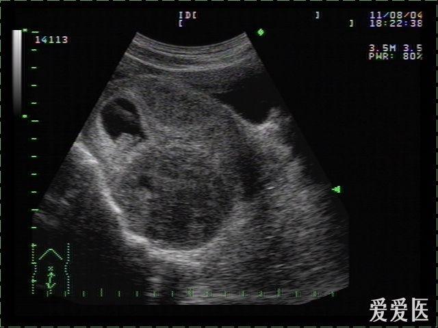 子宫肌瘤伴早孕图片 - 超声医学讨论版 - 爱爱医医学论坛