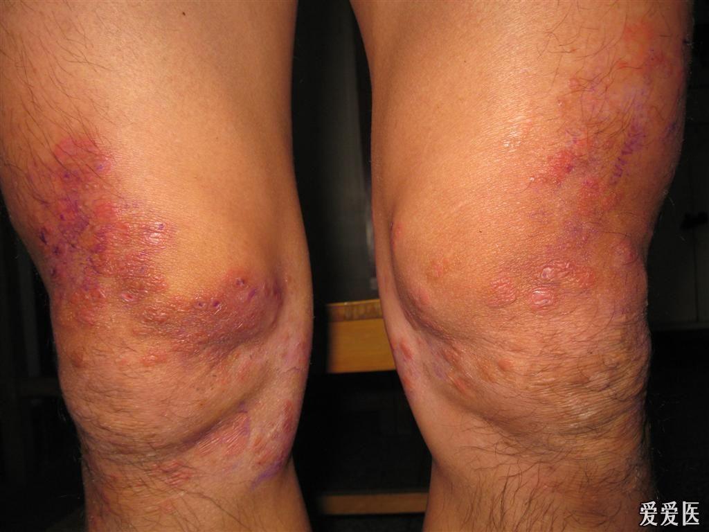 看图识病泛发性体癣