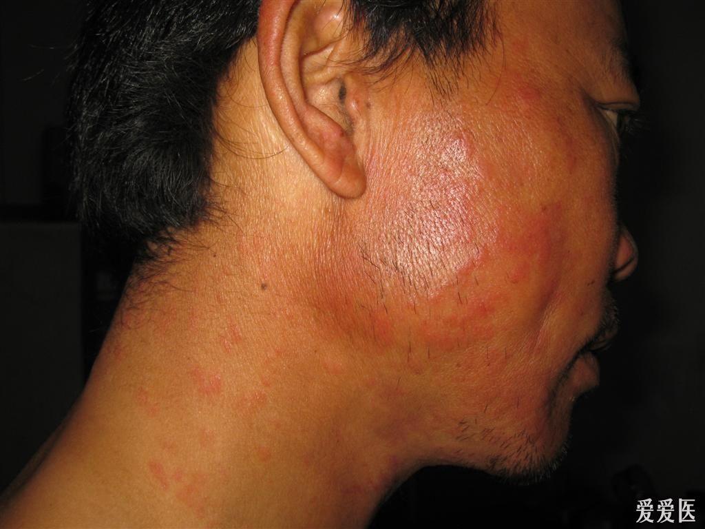 看图识病泛发性体癣