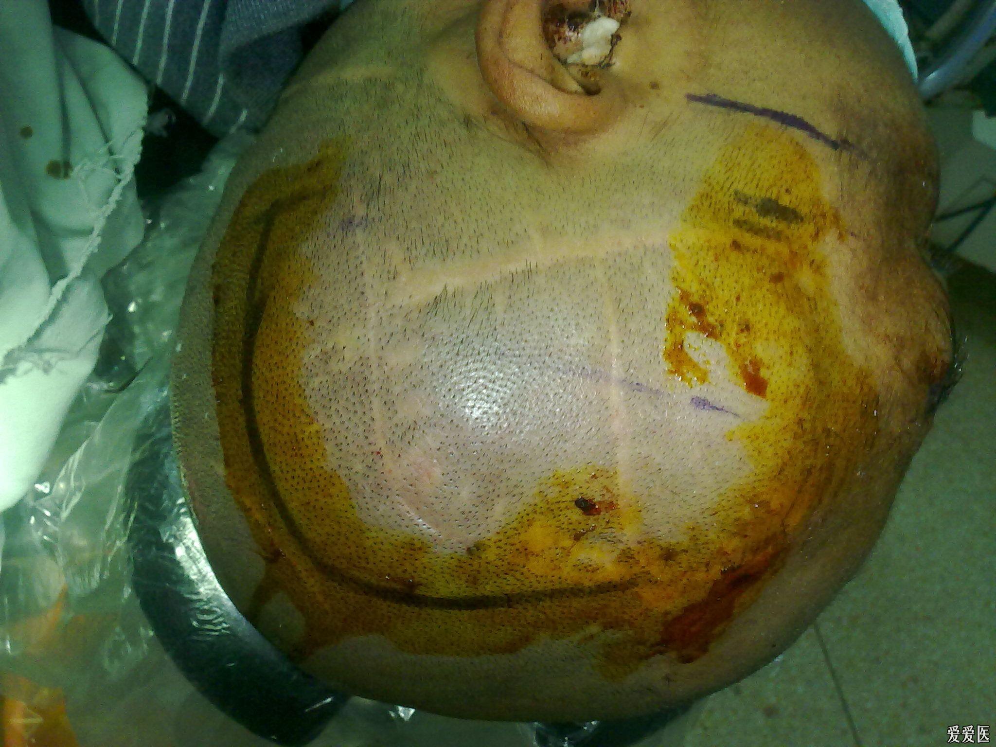 一例少见的脑外伤病例