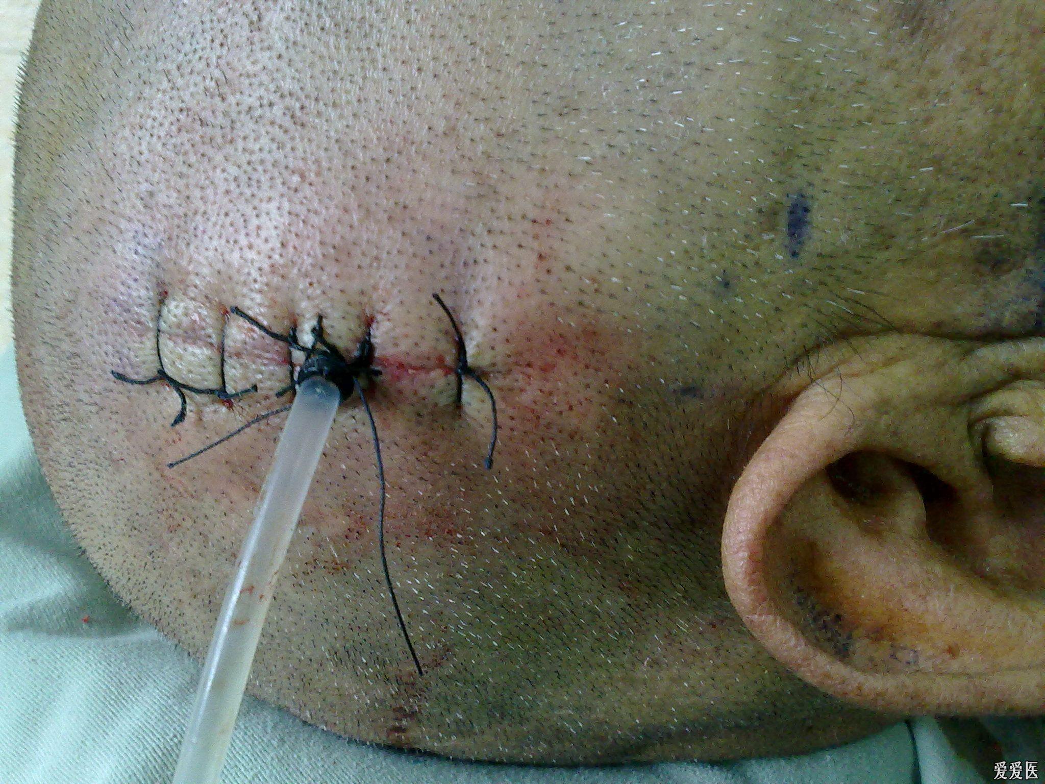 慢性硬膜下血肿