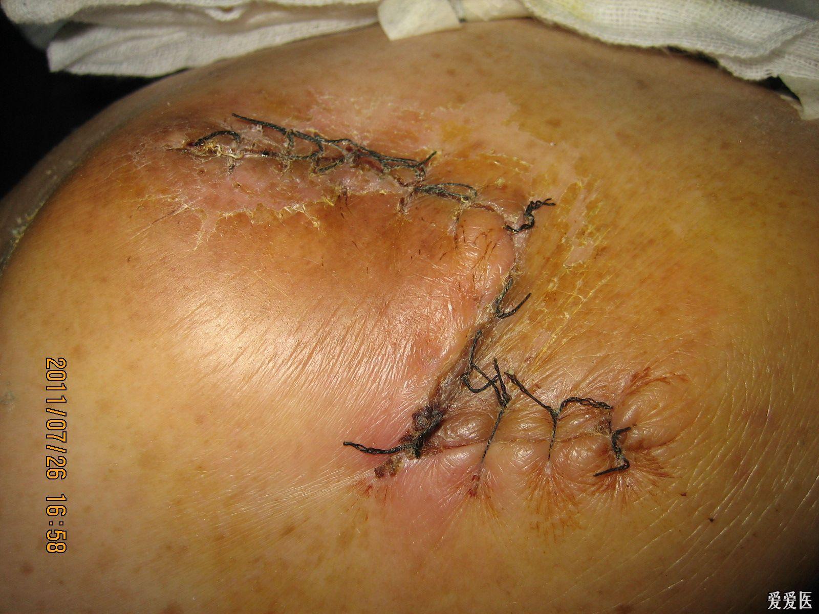 近期做的菱形改良皮瓣在治疗褥疮中的应用