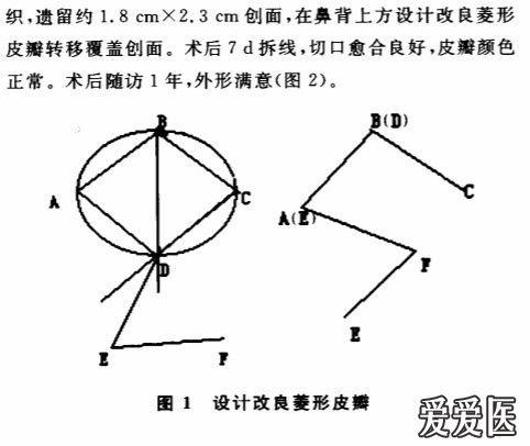 近期做的菱形改良皮瓣在治疗褥疮中的应用