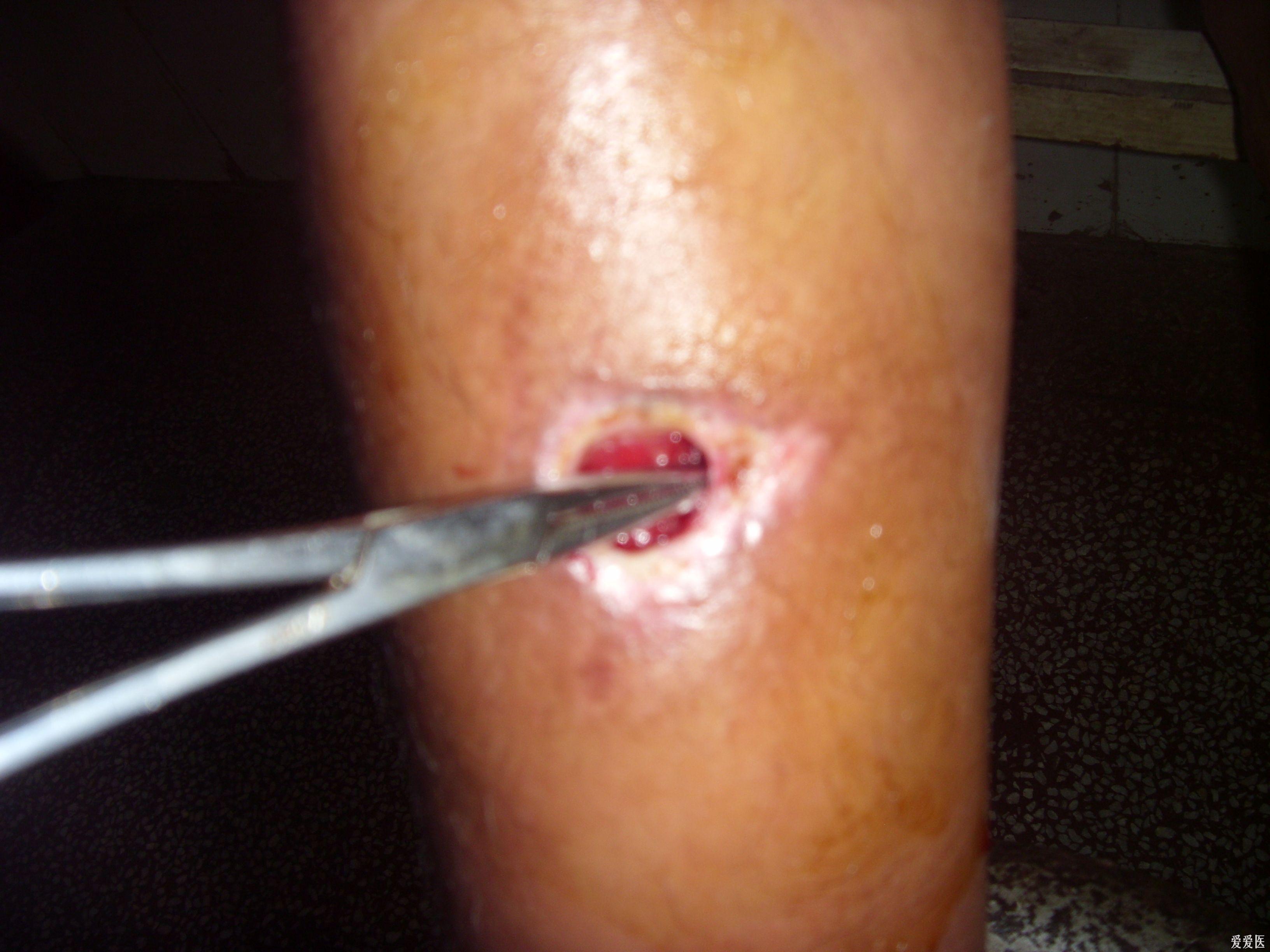 患者,女,14岁,因发生碰撞致右小腿前内侧出现一伤口,在小诊所换药