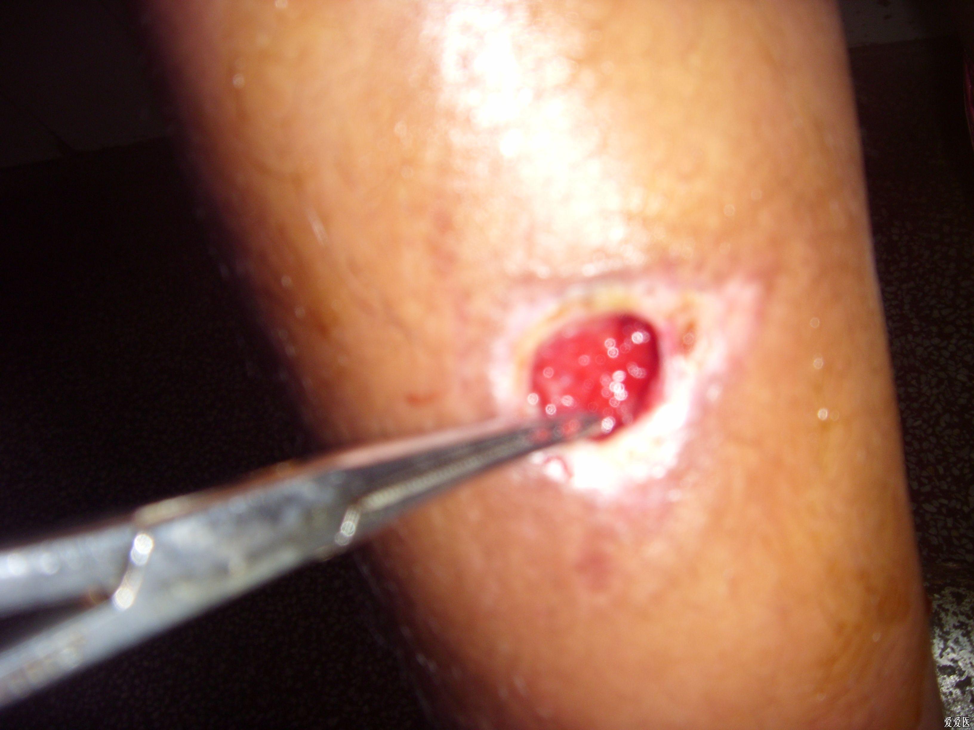 右小腿一溃疡四十天余!大家讨论下治疗方案!