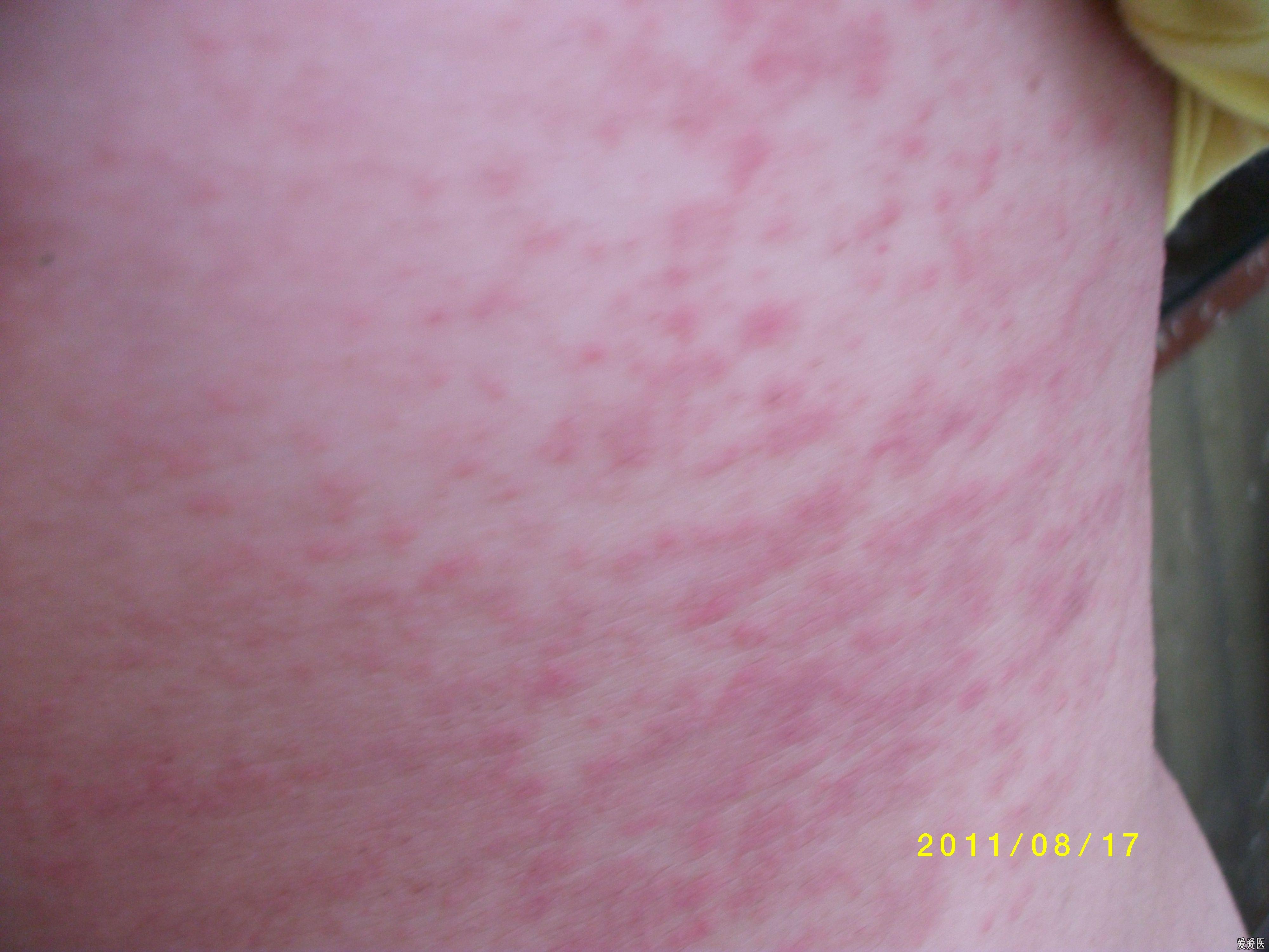 自身敏感性皮炎治疗结果在12楼