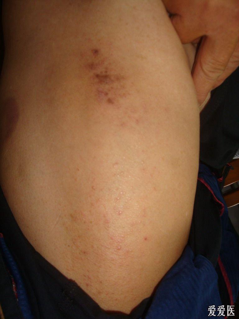 神皮皮肤淀粉样变