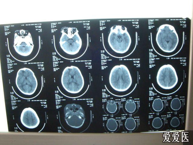 颅骨凹陷性骨折ct 搜狗图片搜索