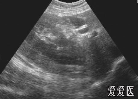 右肾挫裂伤 - 超声医学讨论版 - 爱爱医医学论坛