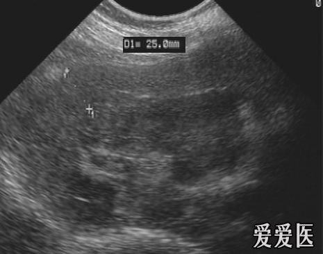 右肾挫裂伤 - 超声医学讨论版 - 爱爱医医学论坛