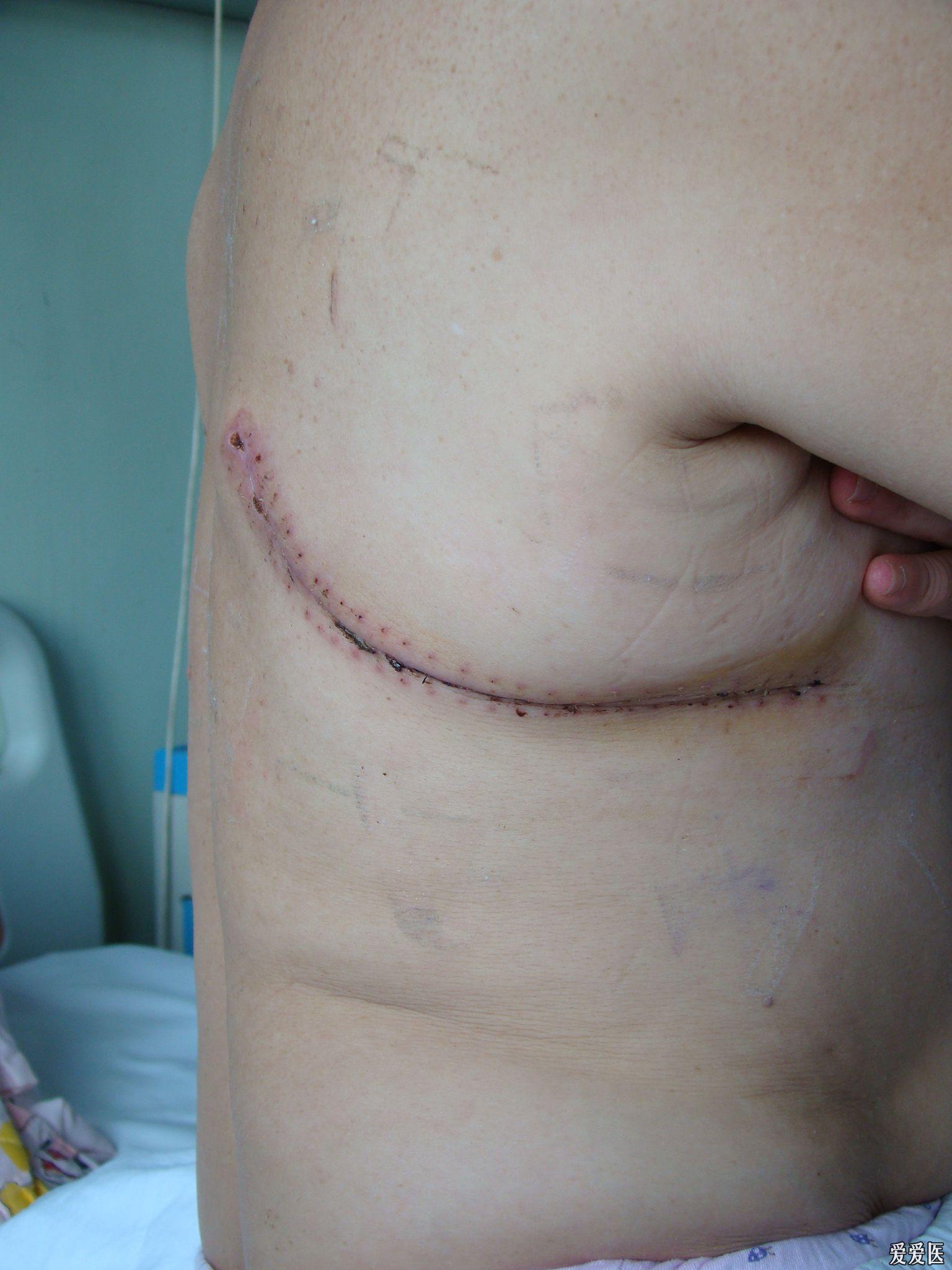 心脏介入手术后伤口图图片