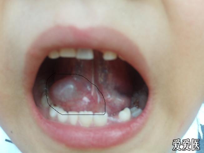 8岁小孩,家长今天无意中发现右侧舌下肿起泡状物,不痛如图