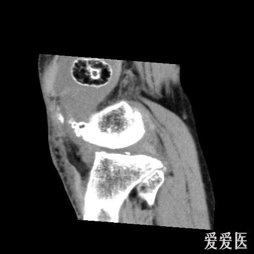 右侧股骨下端滑膜骨软骨瘤病