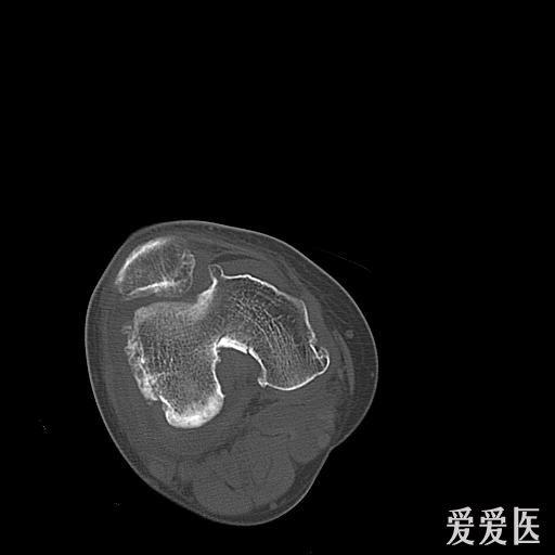 右侧股骨下端滑膜骨软骨瘤病