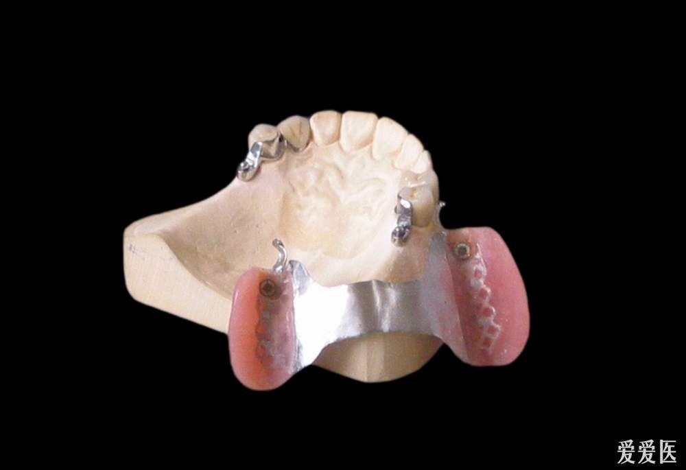 冠内附着体义齿图片图片