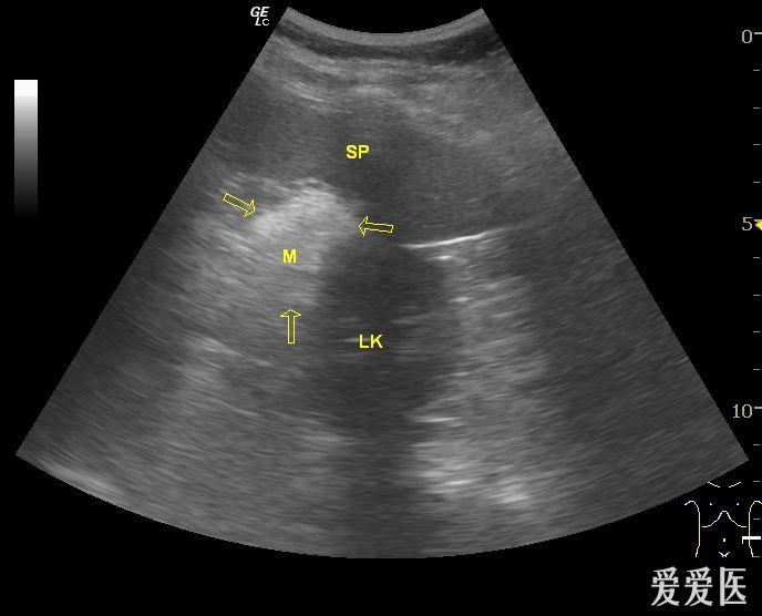 脾门处实质性占位,大家考虑什么?