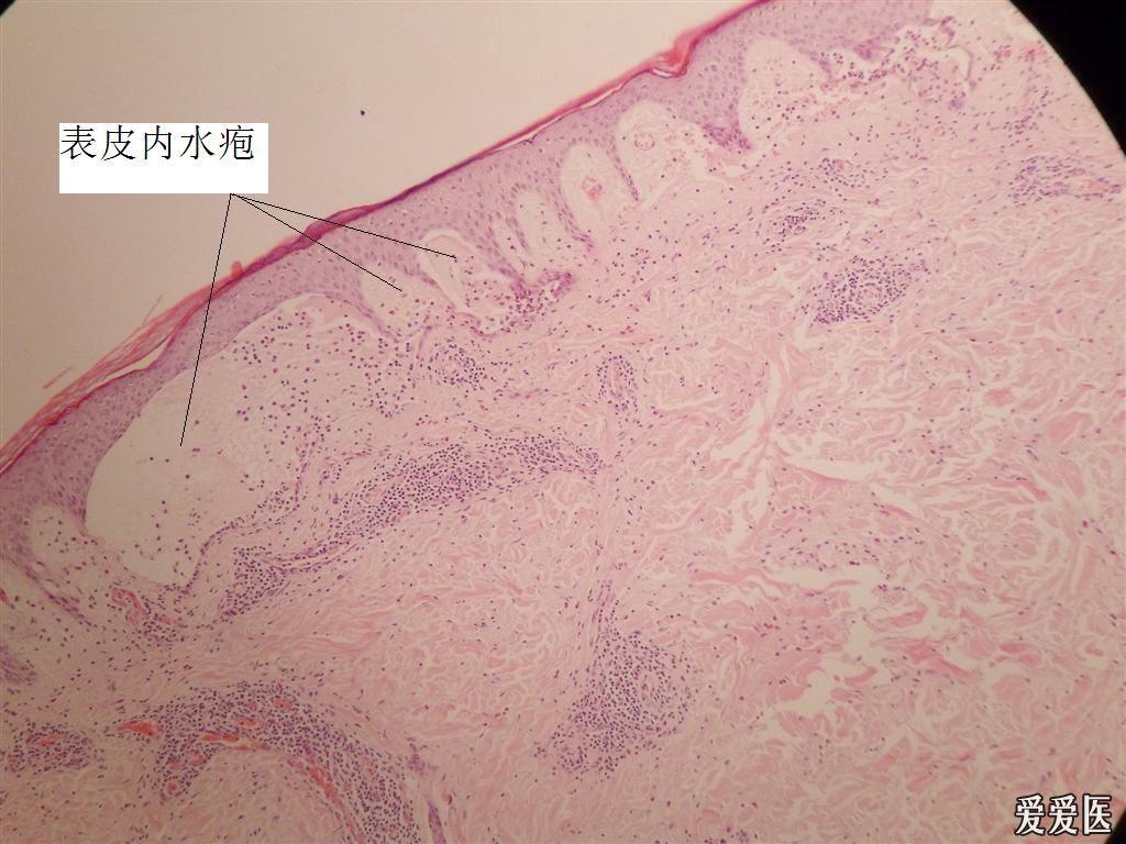 丘疹性荨麻疹(附有病理) - 皮肤及性传播疾病讨论版 - 爱爱医医学论坛