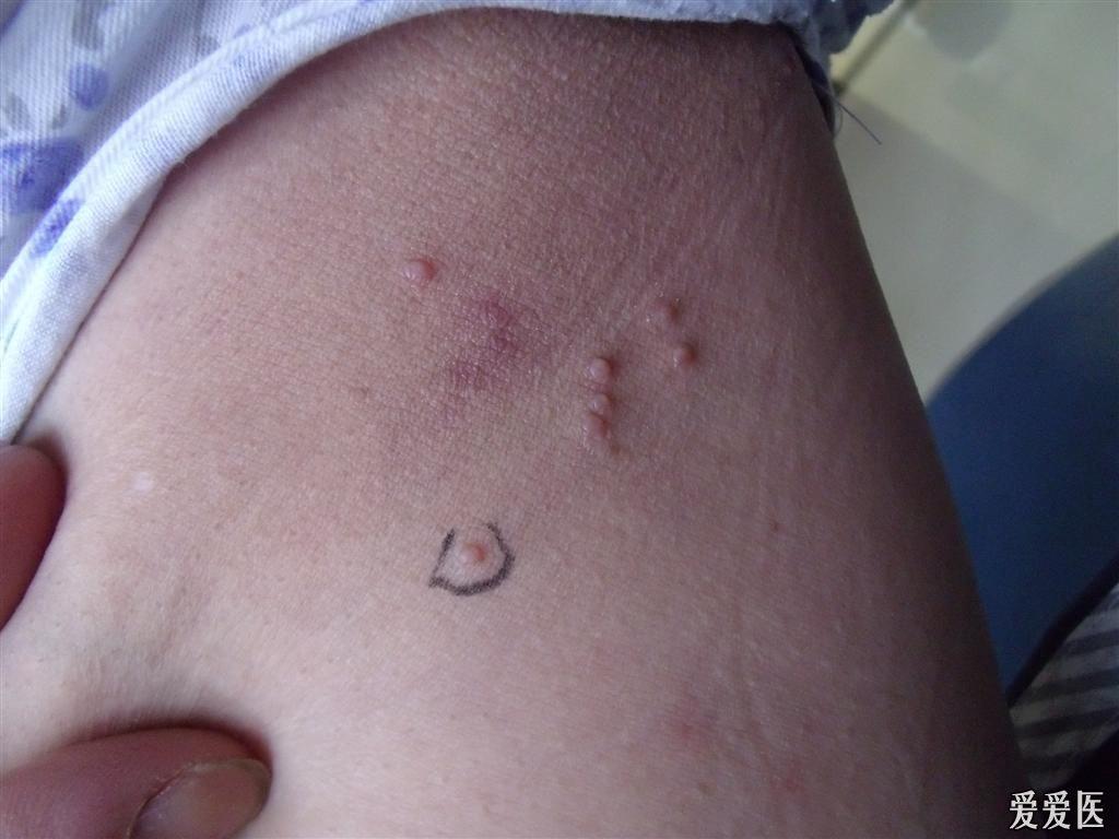 传染性软疣(附有病理) - 皮肤及性传播疾病讨论版 - 爱爱医医学论坛