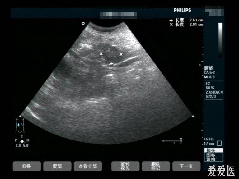 壶腹部占位有病理