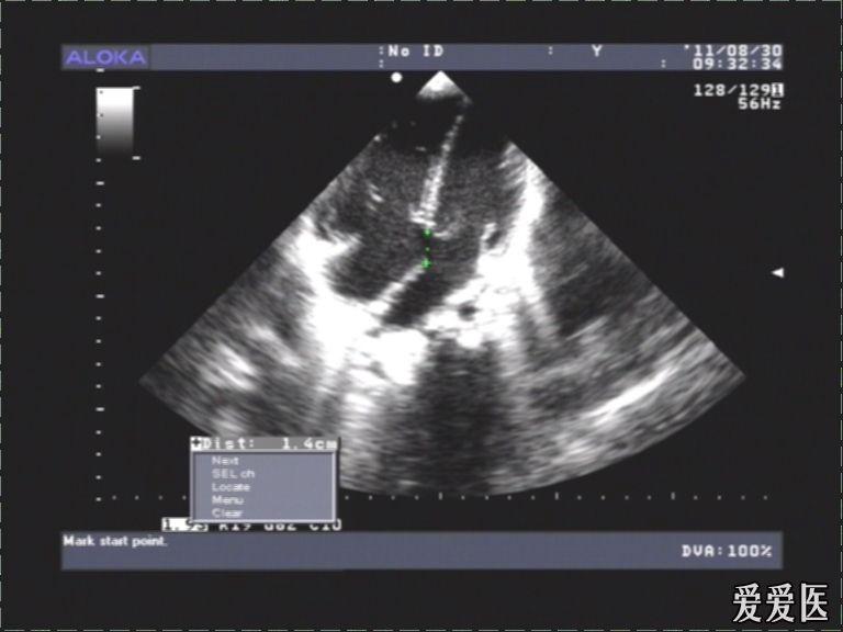 胎儿心内膜垫缺损图片