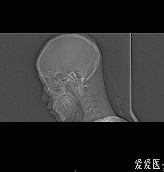 鼻骨骨折x线图片
