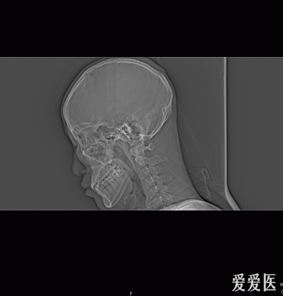 鼻梁骨折图片 x光 拍片图片