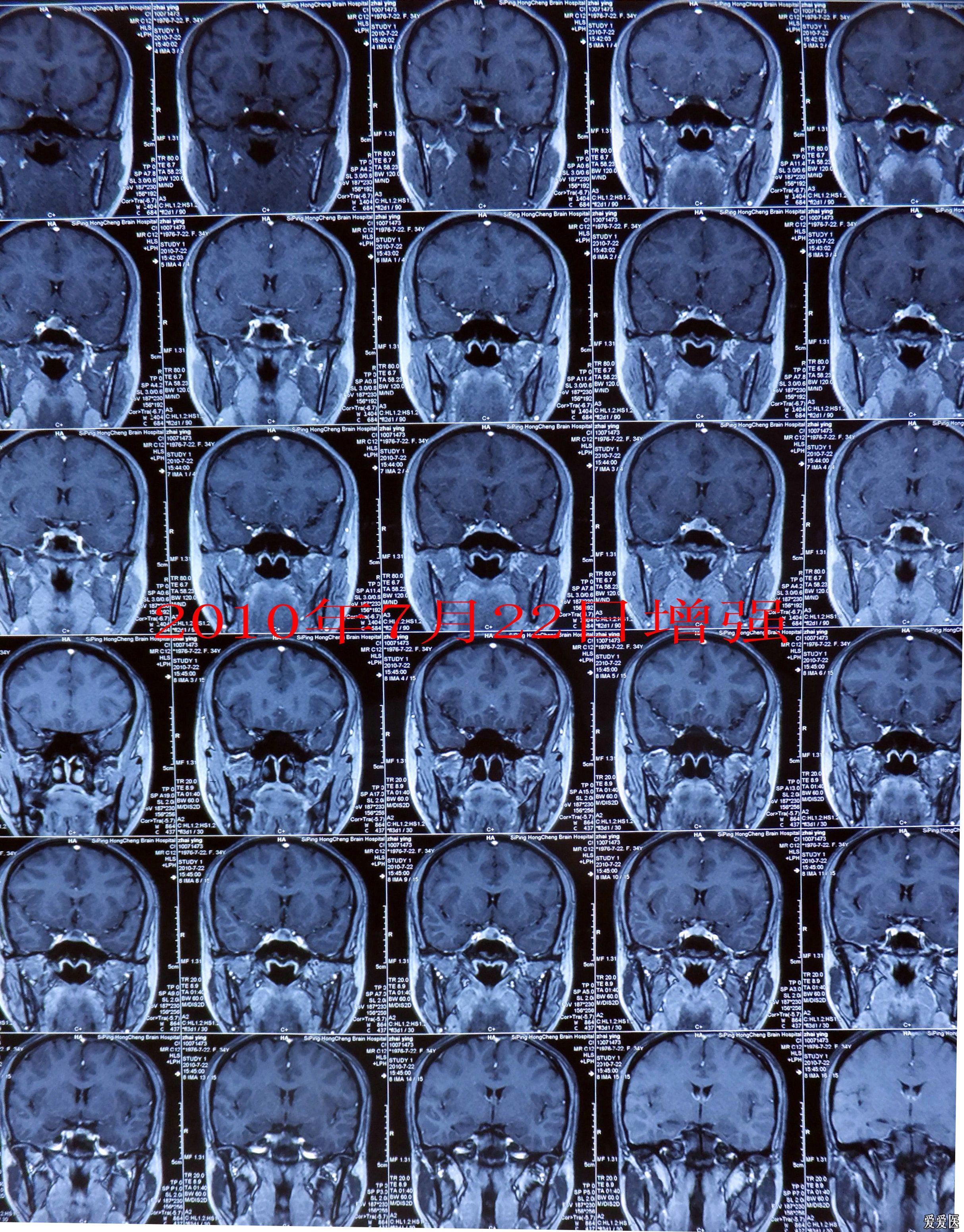 脑垂体磁共振图片