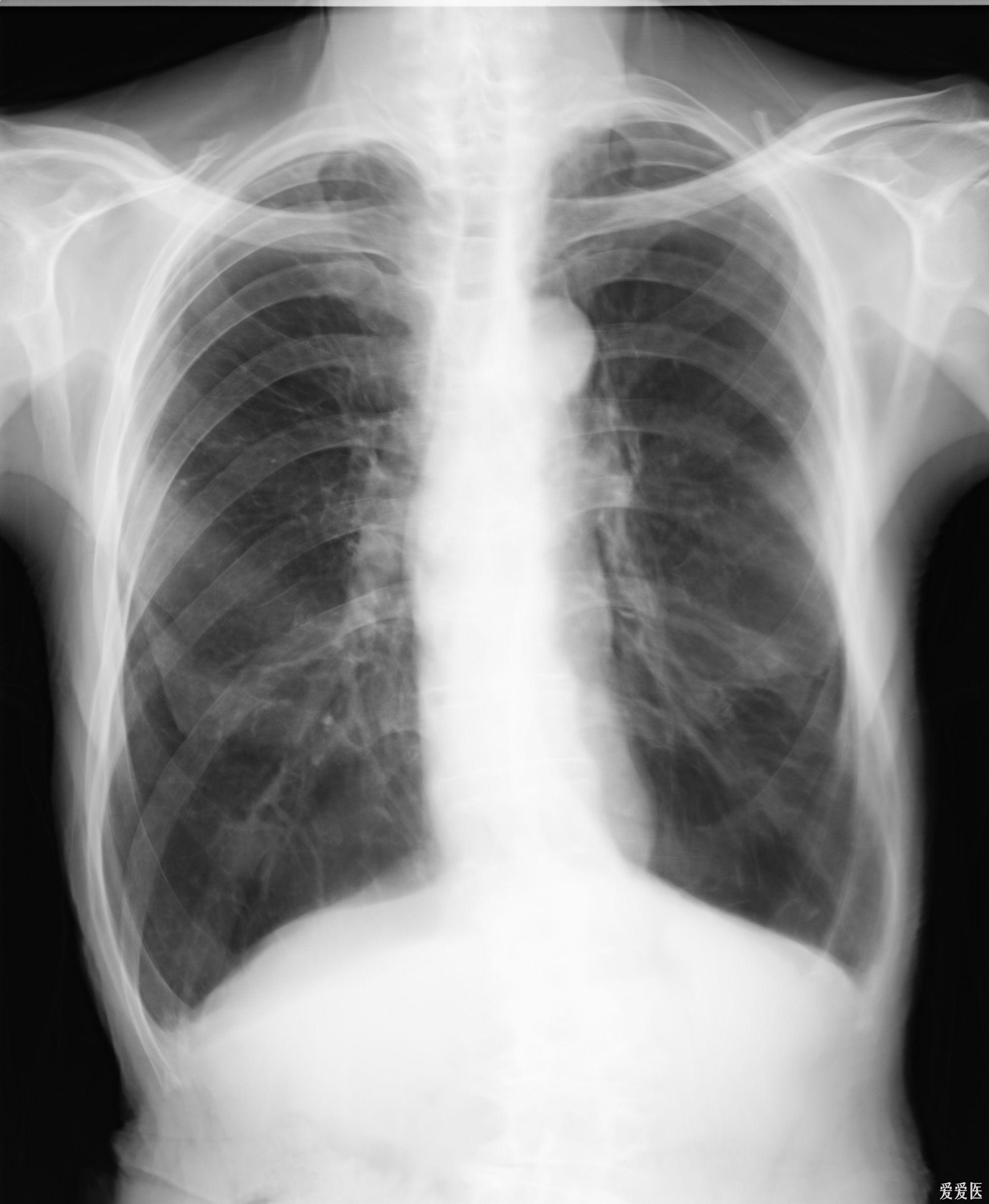 右肺下叶背段结节图片