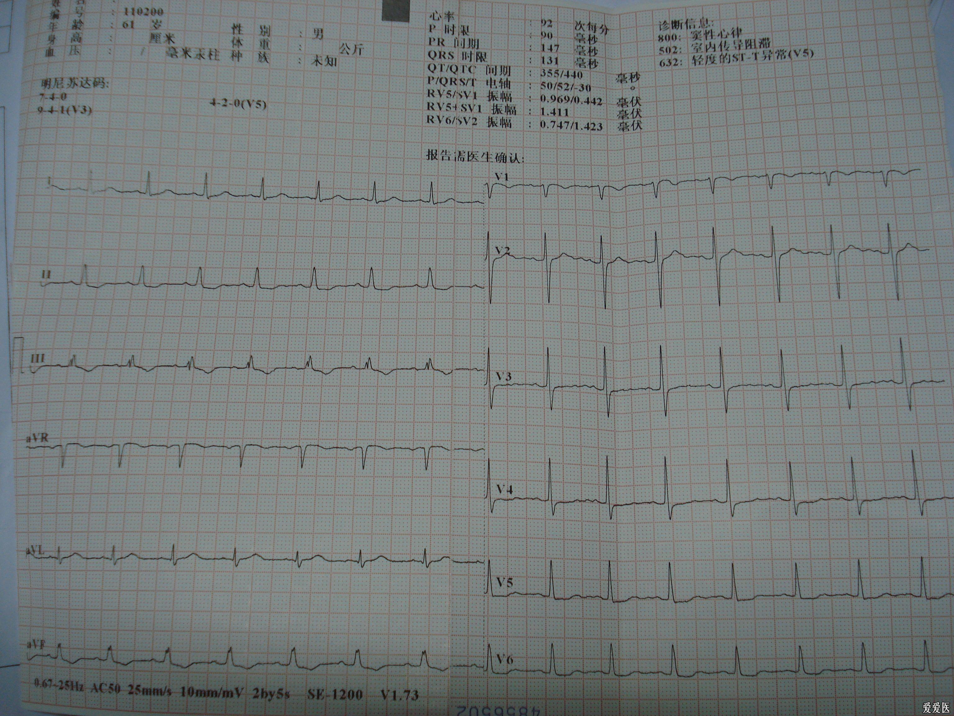 异常q波心电图图片图片