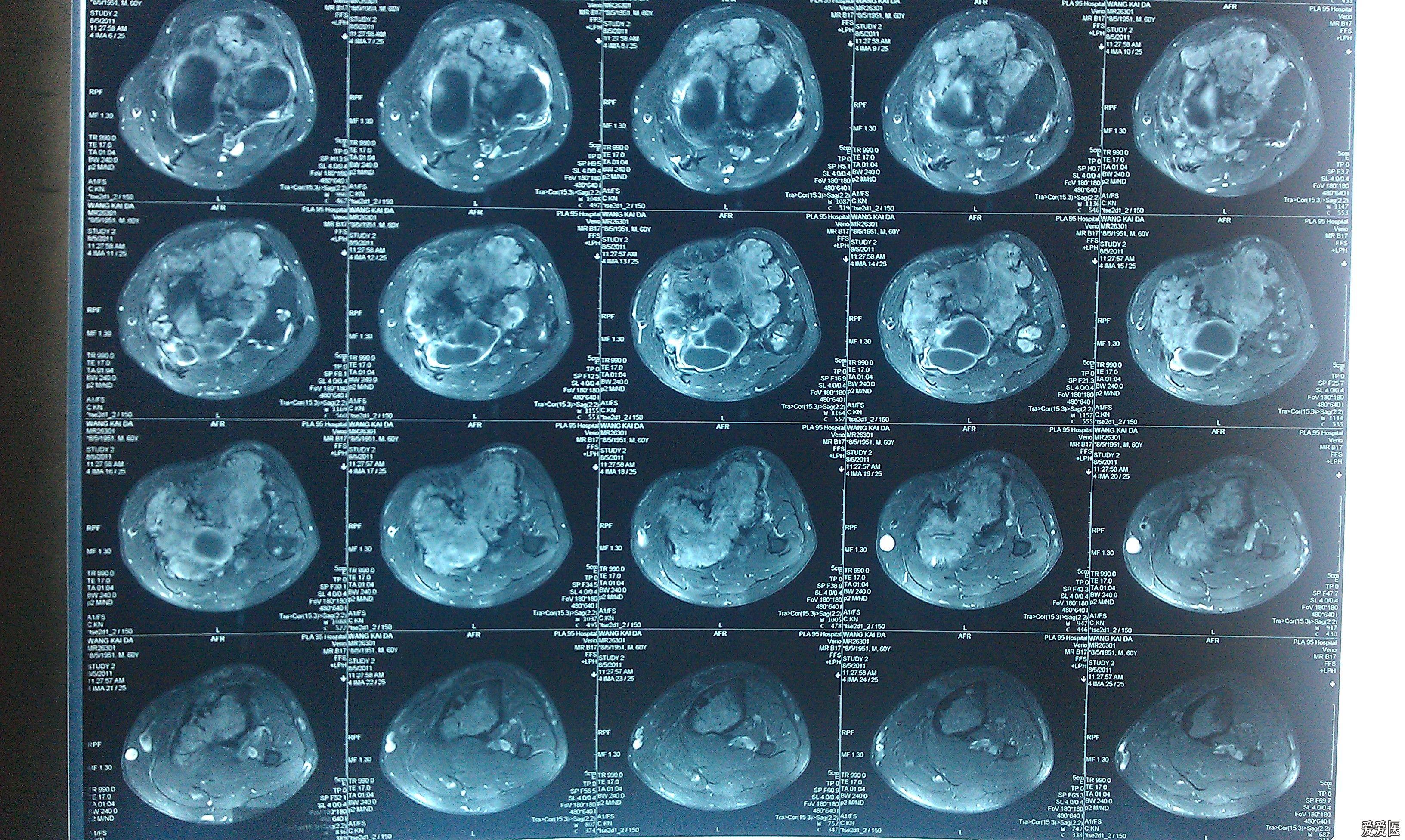 左胫骨平台骨巨细胞瘤一例