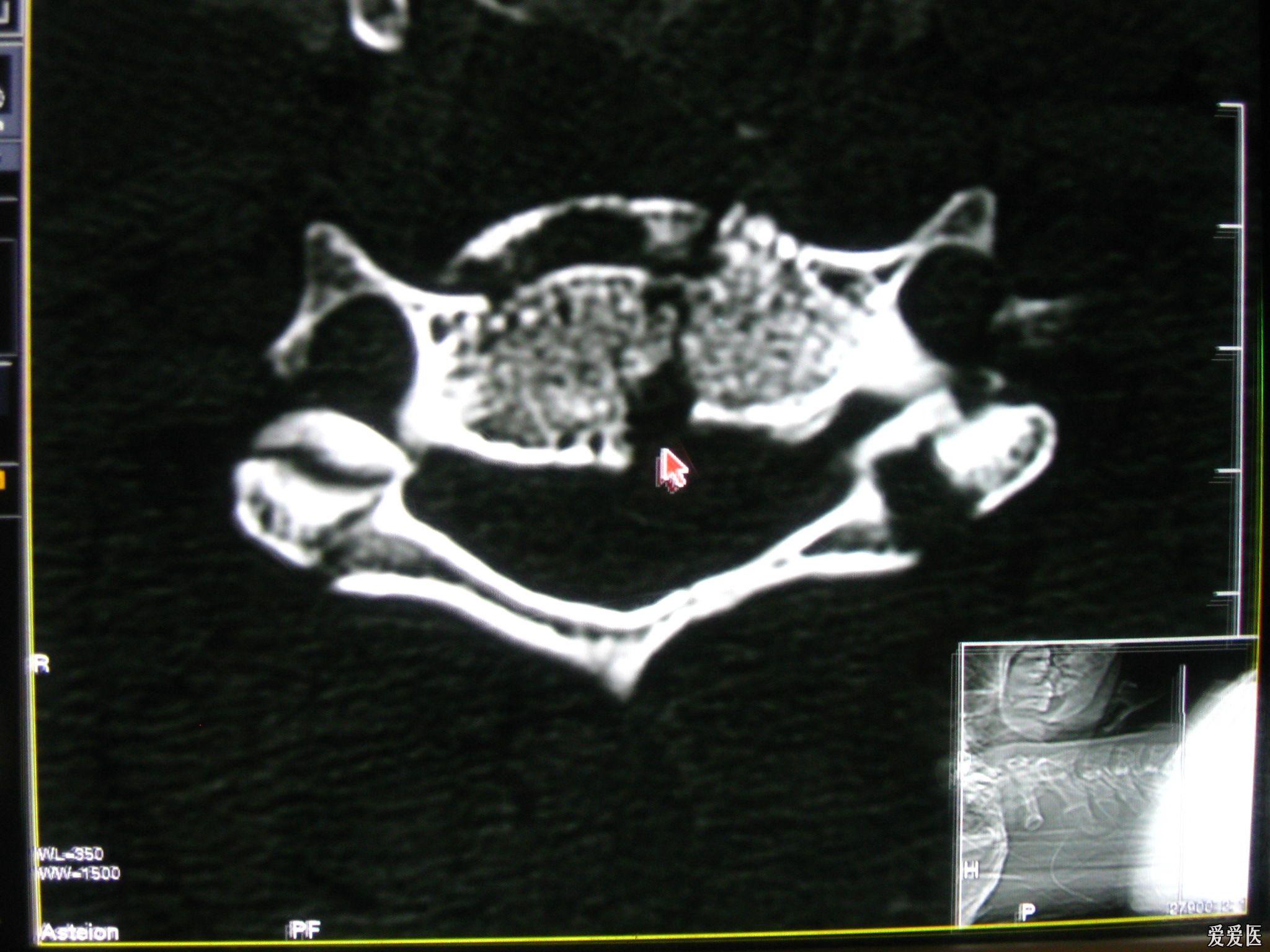 外伤,颈椎骨折(经典)