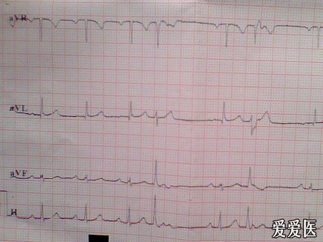 请问是交界性早搏吗? - 心电图脑电图专业讨论版 - 爱爱医医学论坛