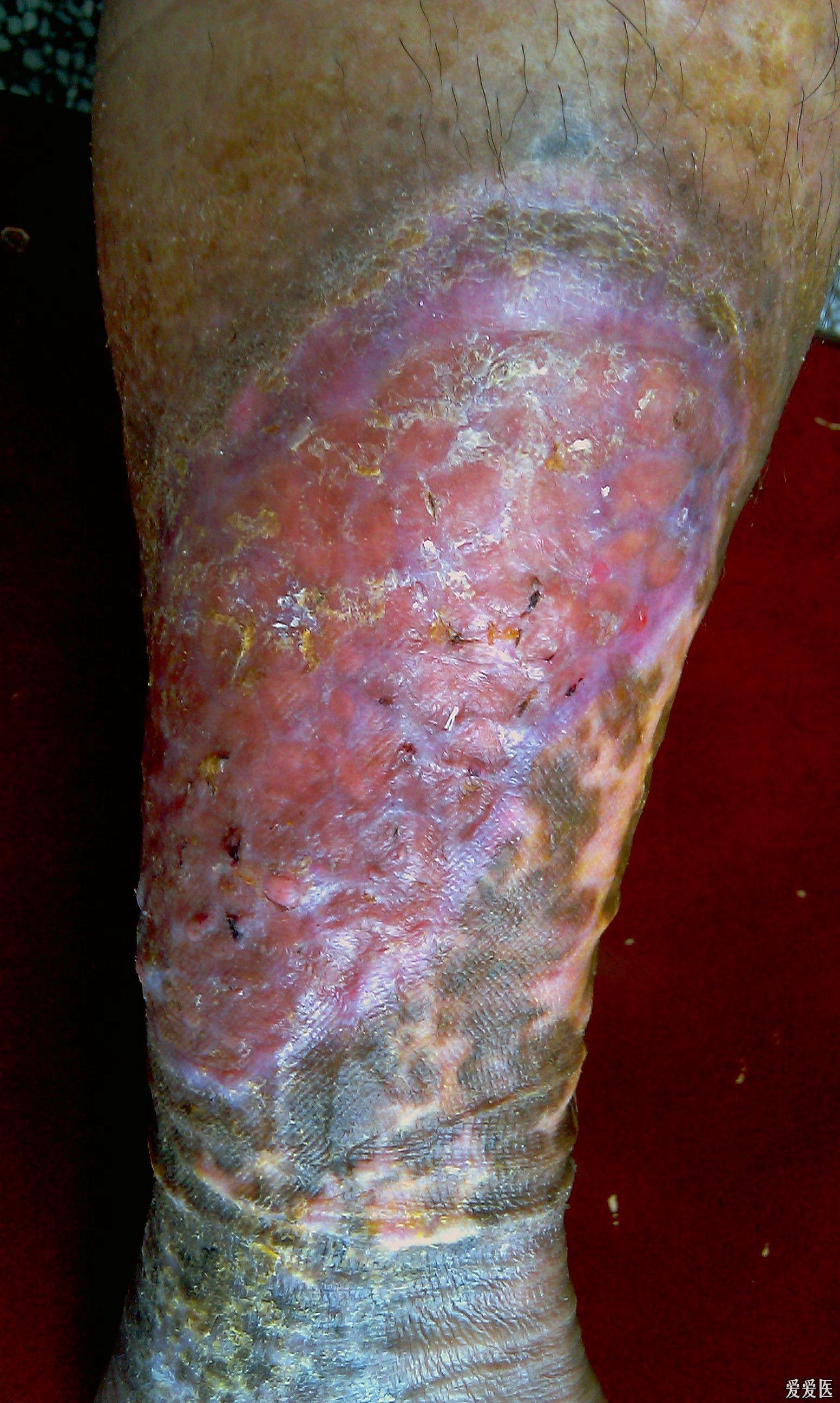 右下肢巨大溃疡