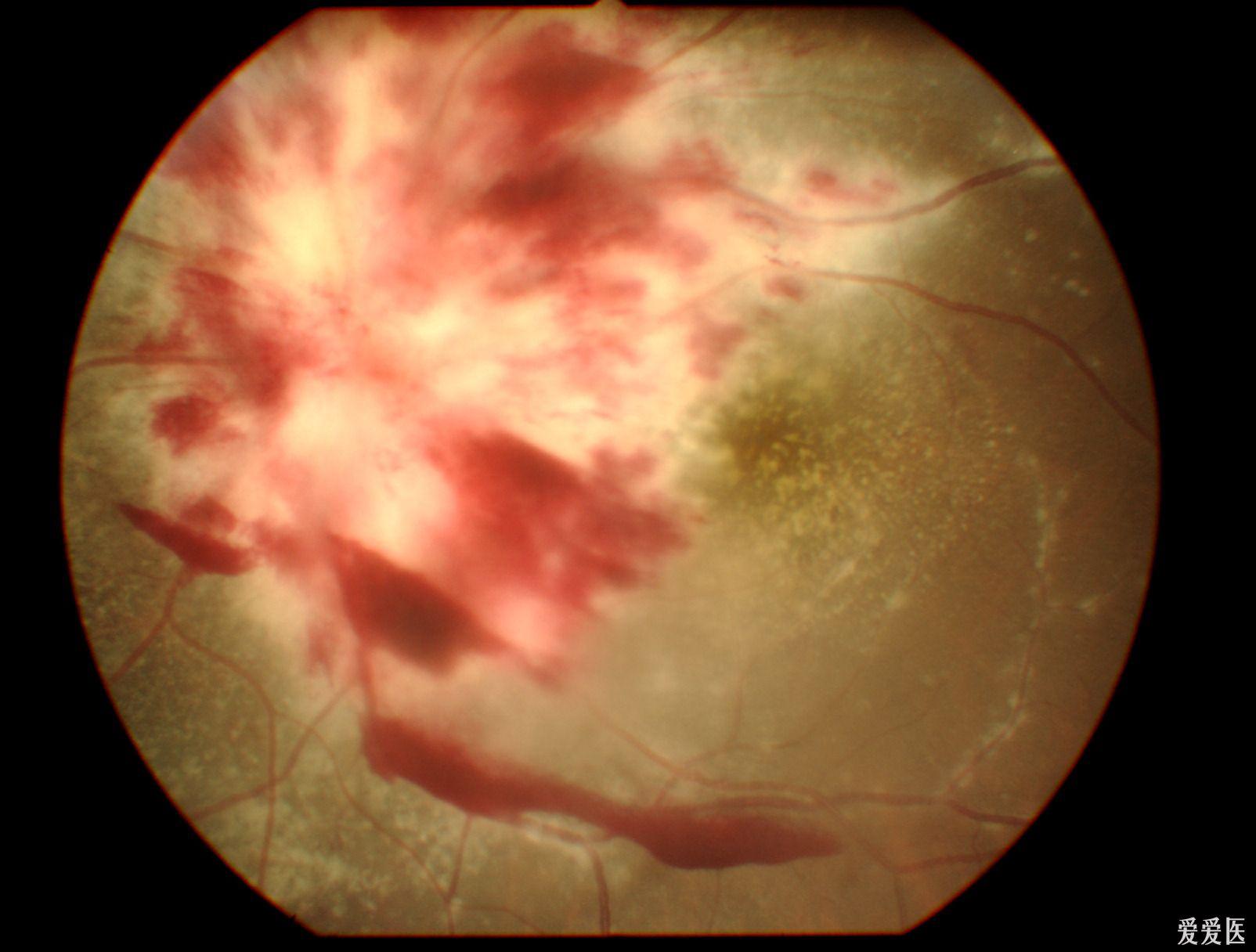 很特殊眼底病变照片