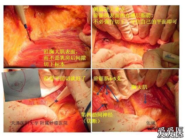 乳腺癌手术切口示意图图片