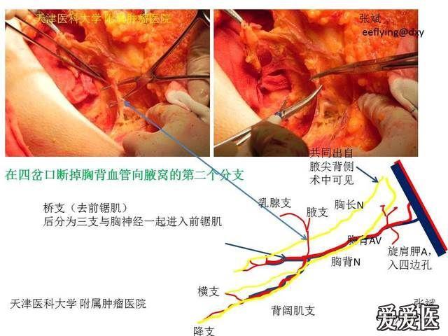 乳腺癌手术过程图解图片