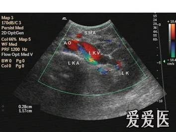 胡桃夾綜合徵