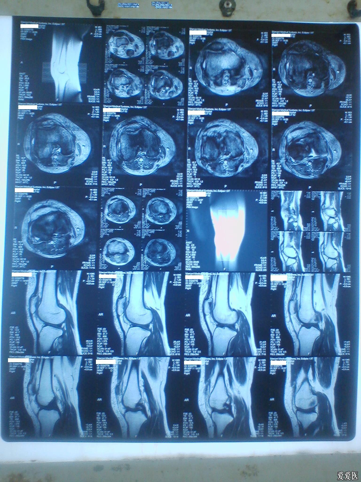 请各位老师看看髌骨那个低密度影是什么