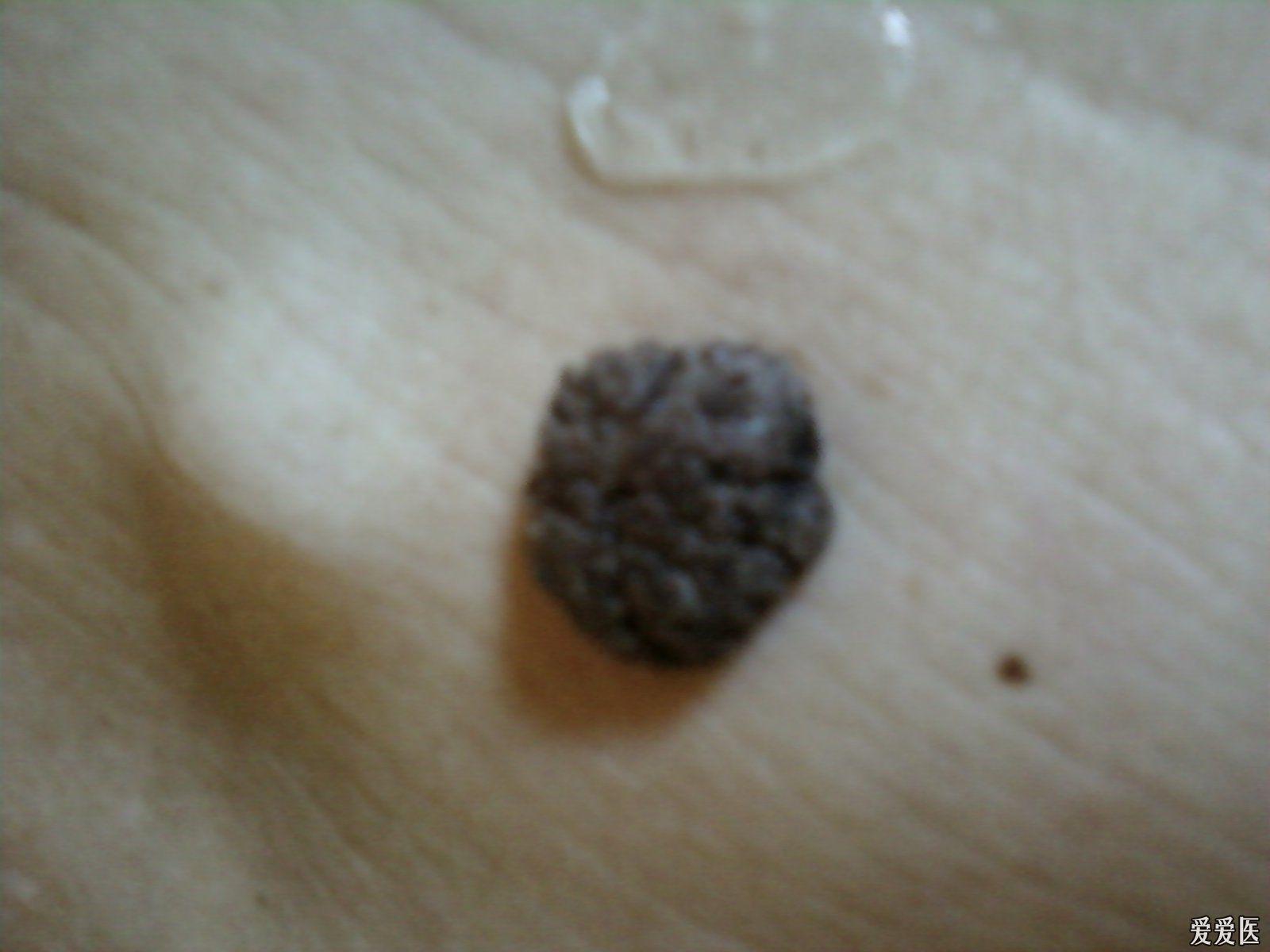 这个是什么dk312注脂溢性角化病