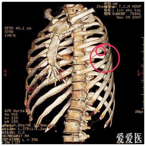 肋骨斷13根2個月沒發現有可能嗎