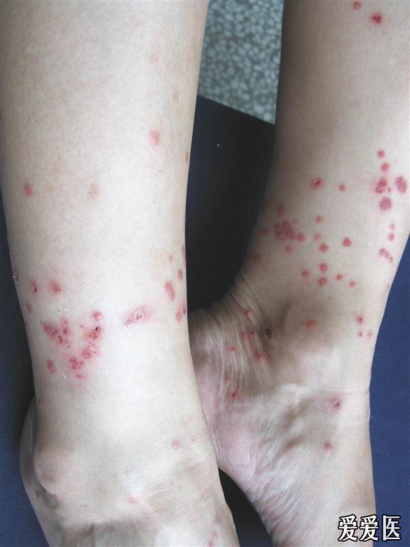 丘疹性荨麻疹症状图片图片