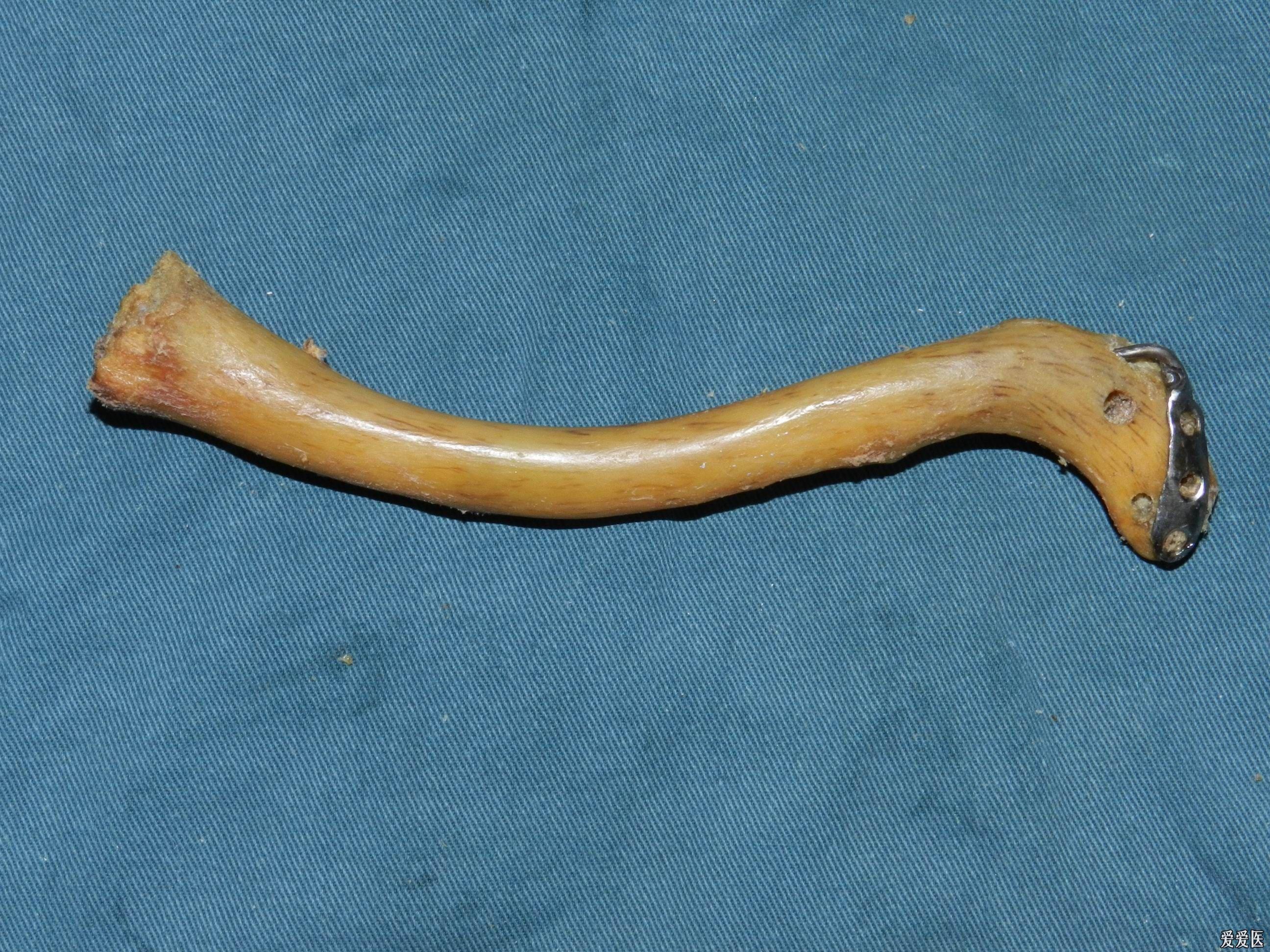 路过必看新型专利一种新型锁定碎骨弹性髓内钉作为固定锁骨中段骨折