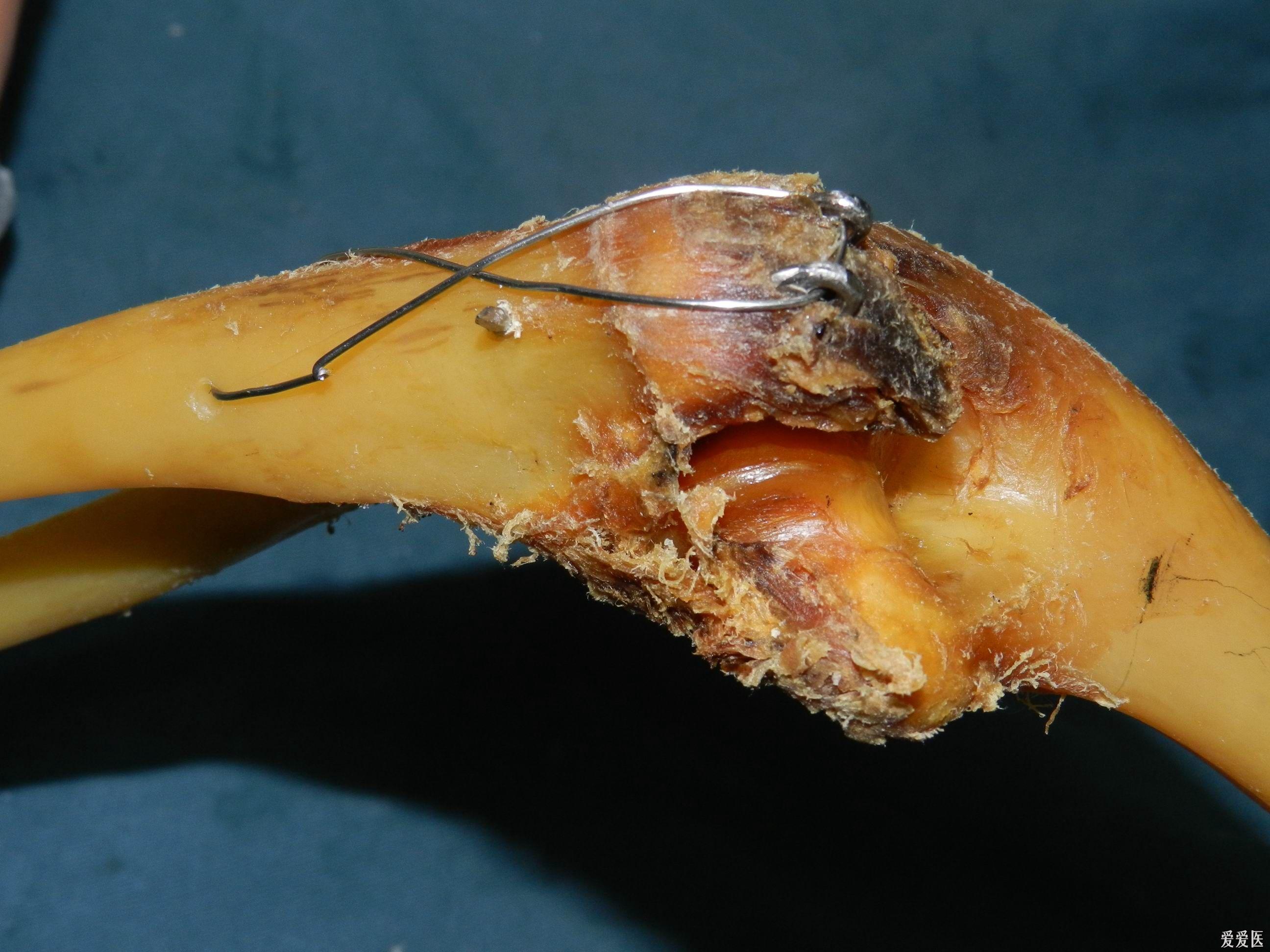 路过必看新型专利带孔钩的克氏针张力带治疗尺骨鹰嘴骨折