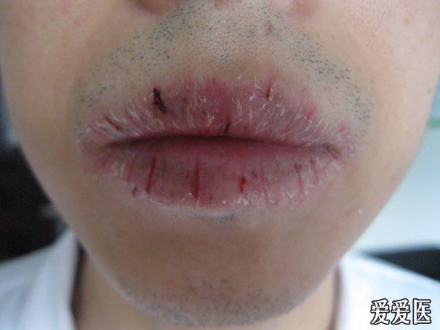 复发性唇炎