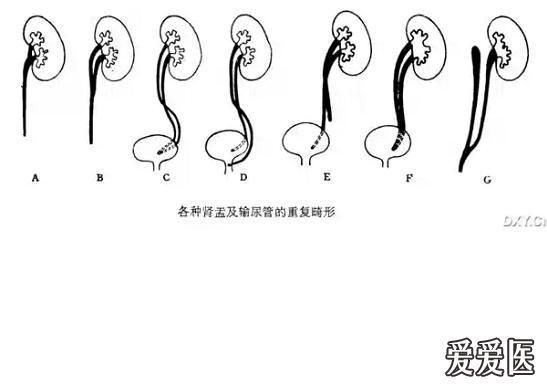 胎儿重复肾图片