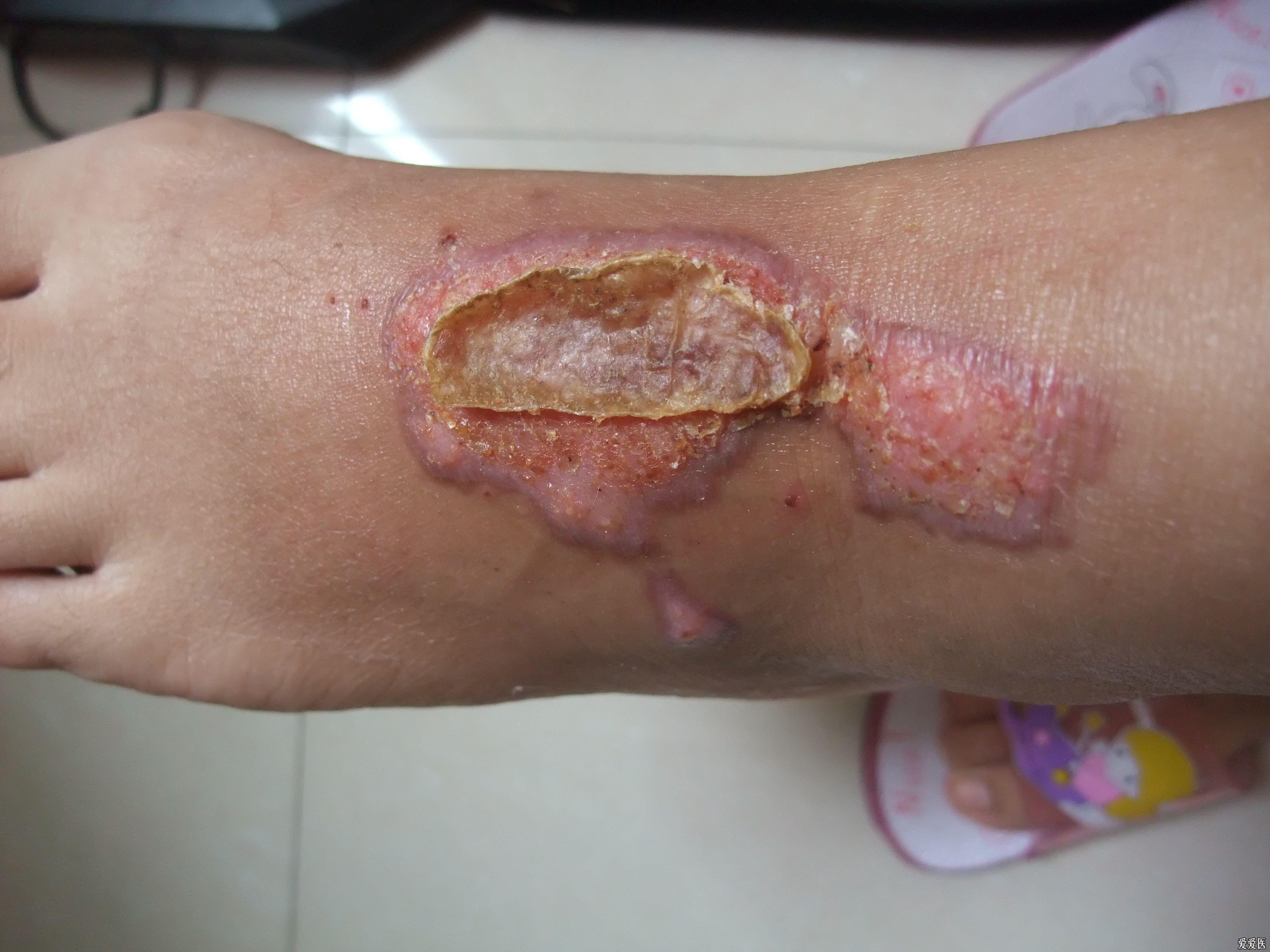 大家帮看看脚背擦伤