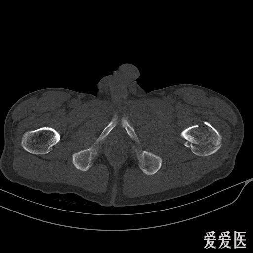 左側尺骨鷹嘴骨折左側股骨頸基底及髖臼前緣骨折粗隆間粉碎性骨折