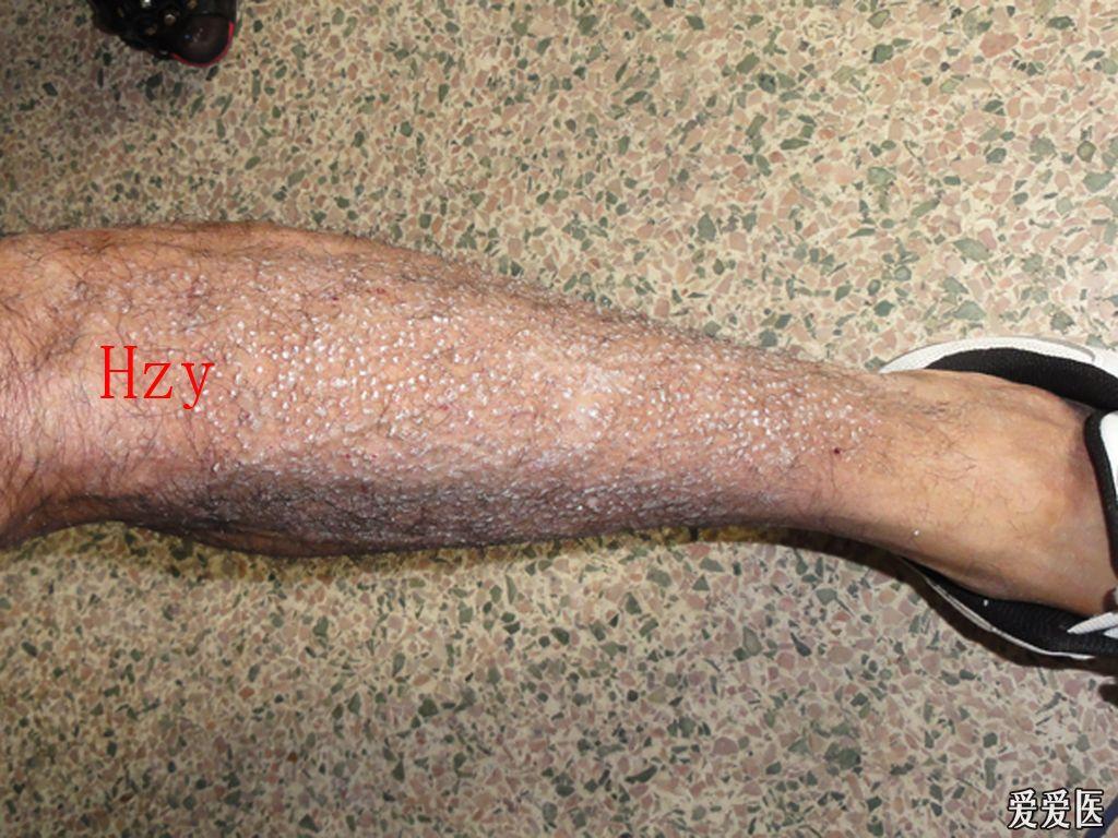 看图诊病---------皮肤淀粉样变 - 皮肤及性传播疾病讨论版 - 爱爱医