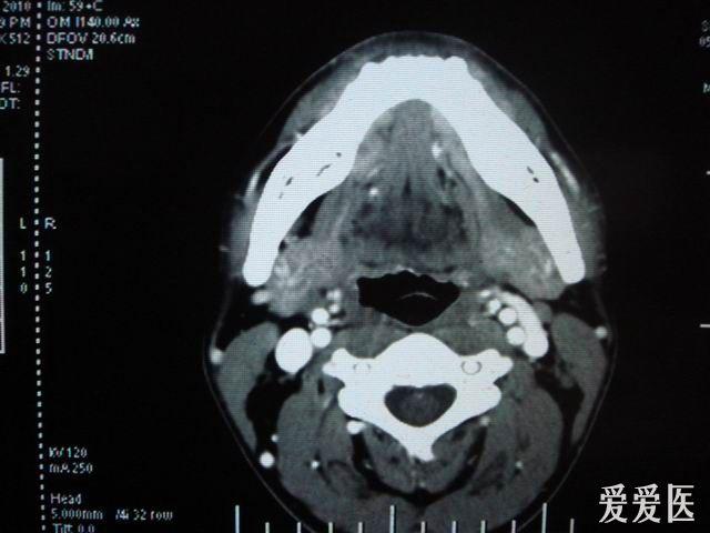 單側鼻咽部頸部強烈異物感扎痛.異物?莖突綜合徵?請各位愛友發表意見.