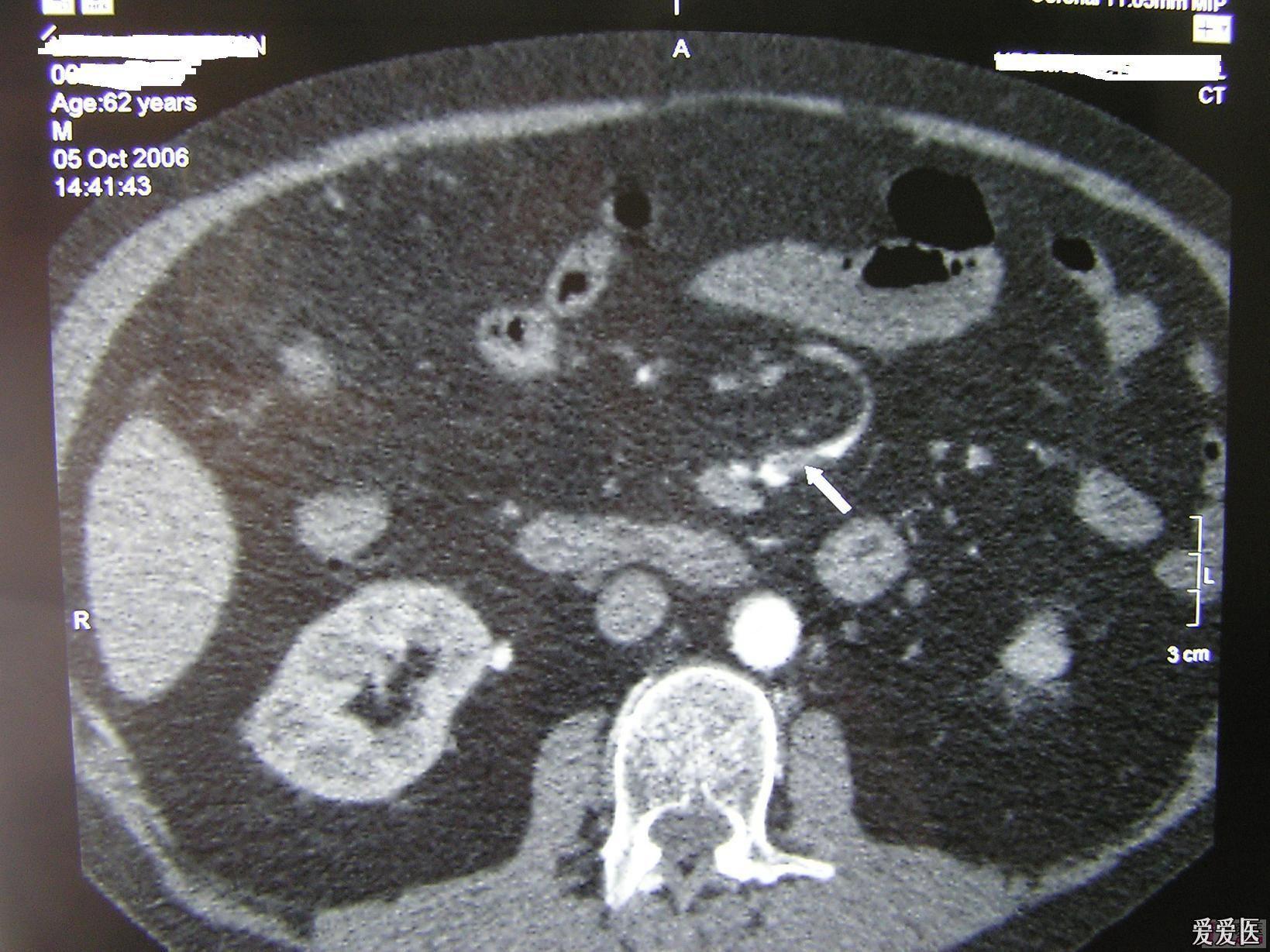 急腹症肠系膜上动脉栓塞smae误诊分析请进